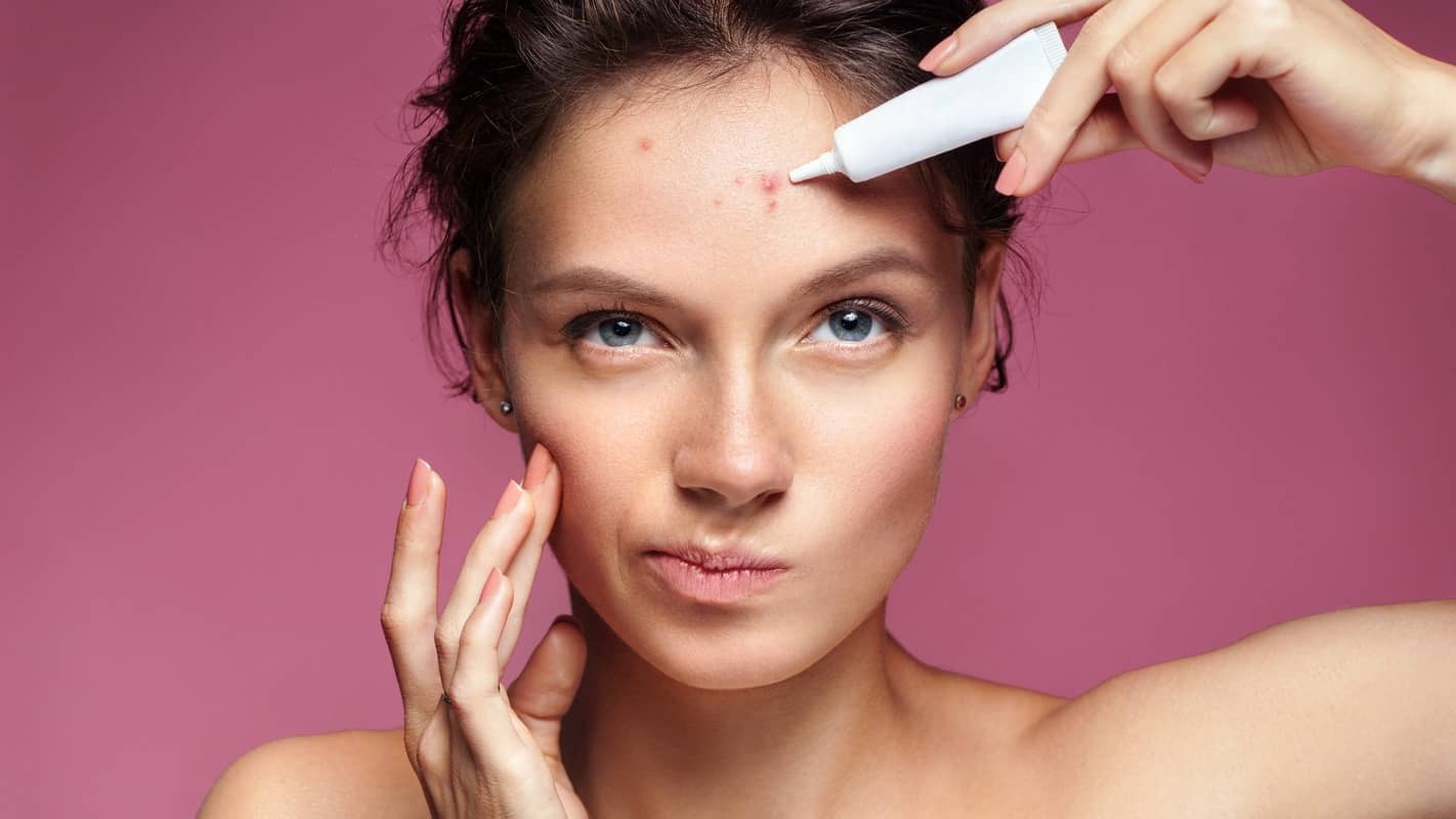 baby acne