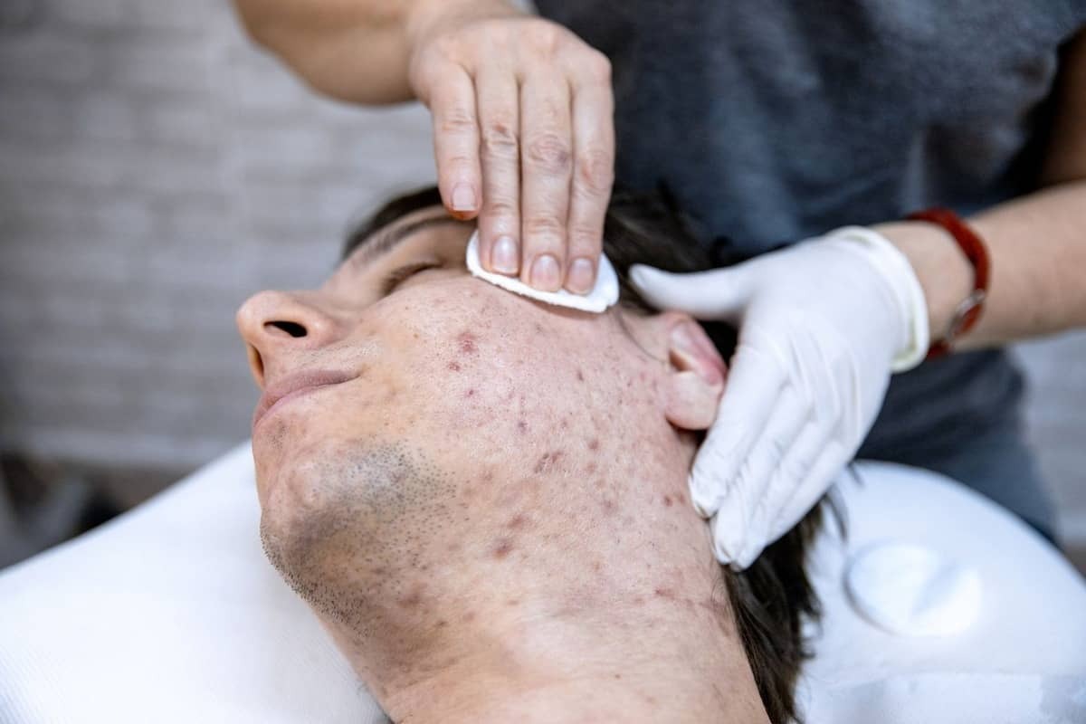 cystic acne