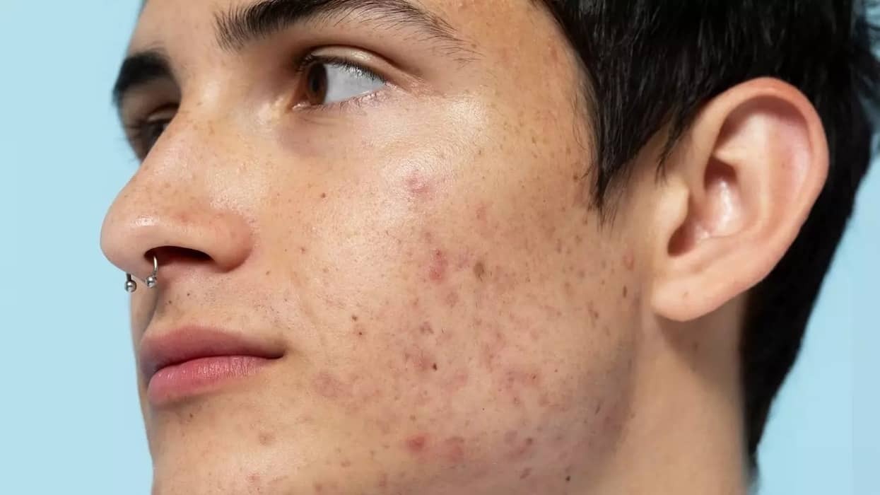 fungal acne